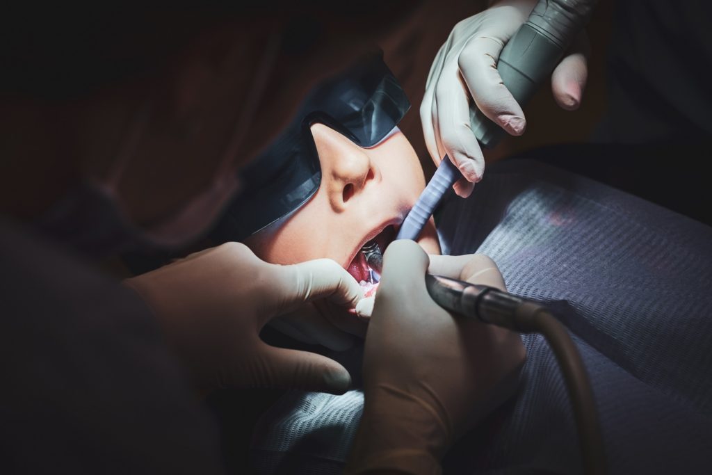 sealants, Root Canal Therapy